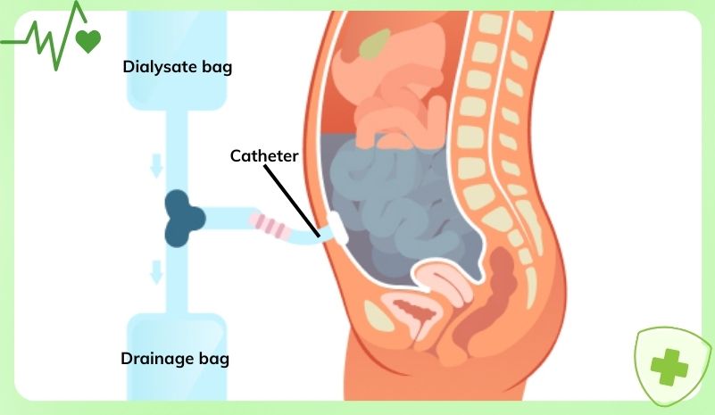 Lọc máu màng bụng Lọc máu màng bụng