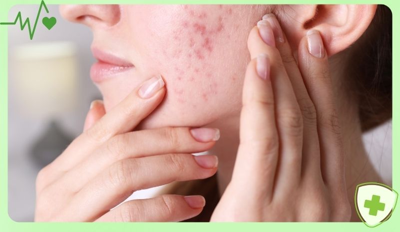 Da xỉn màu, sạm, nổi nhiều mụn ẩn